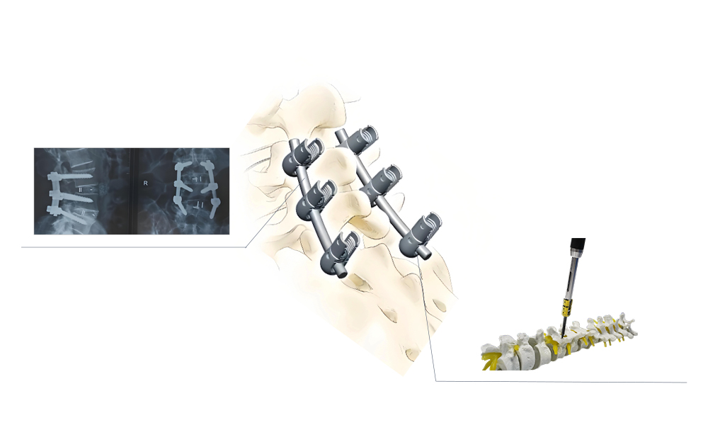 Spinal Pedicle Screw System Three-Dimensional Spinal Stability