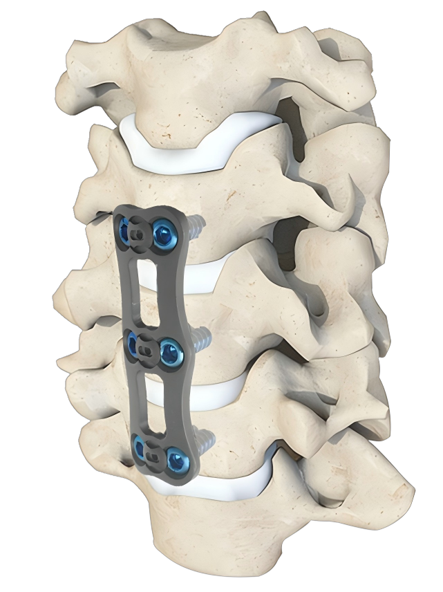Anterior cervical plate fixation on the cervical spine