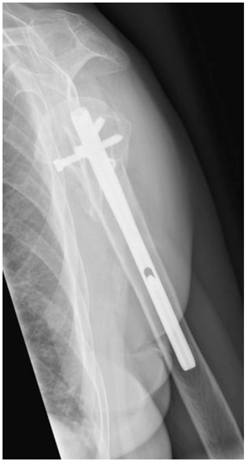 Lateral radiograph at two years confirming stable anatomic alignment