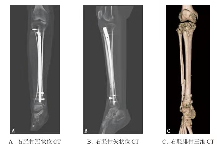 Representative X-ray of tibia and fibula fracture with intramedullary nail fixation