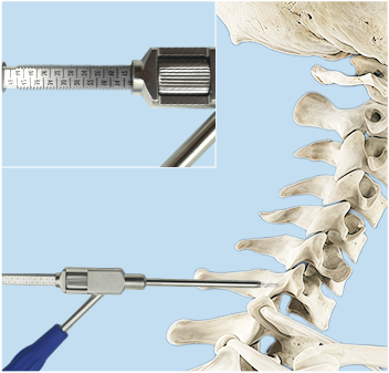 Screw canal preparation illustration