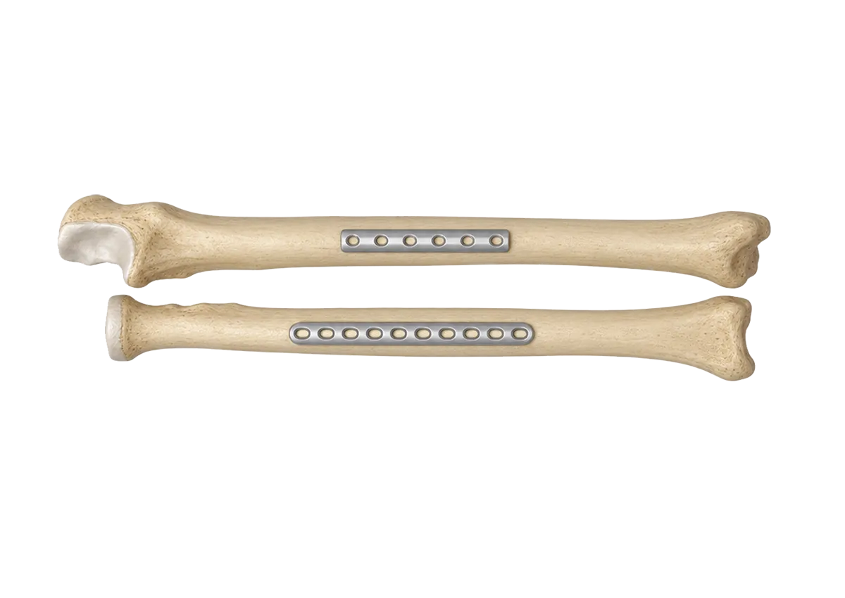Plate fixation application on both radius and ulna shafts