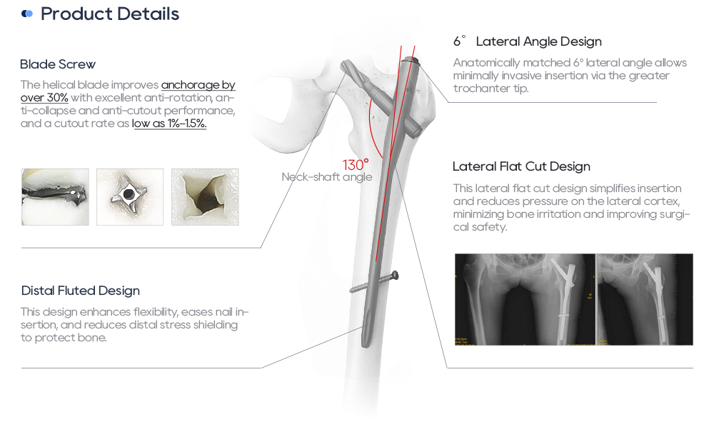 PFNA интрамедуларен пирон | Фиксиране на фрактура на проксимална бедрена кост