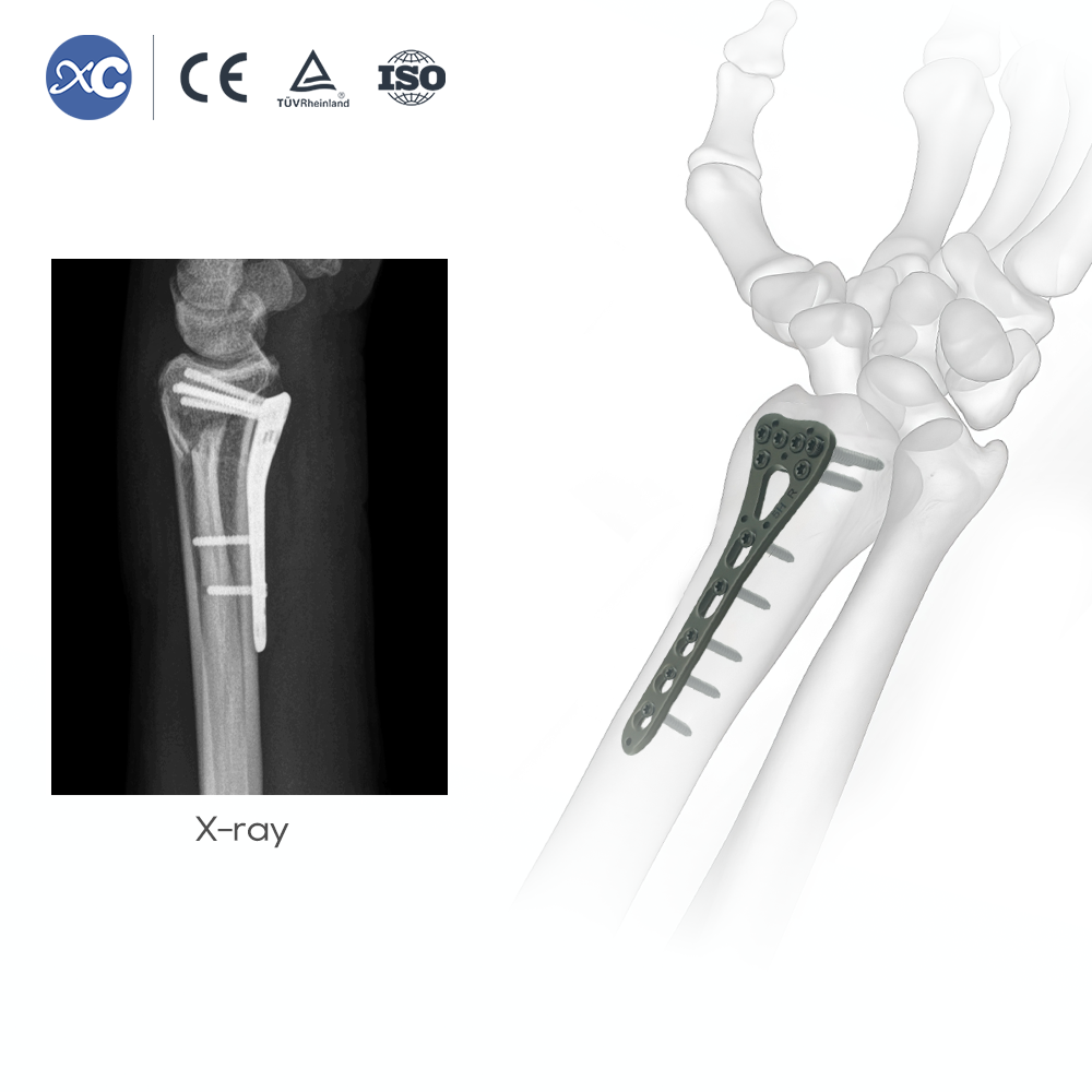 Distal Radius Instrument Set - XC Medico