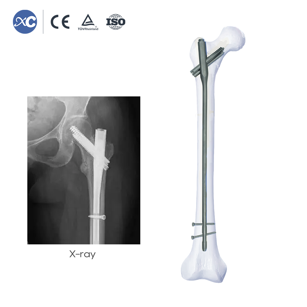 Intertan Nail System | xc medico