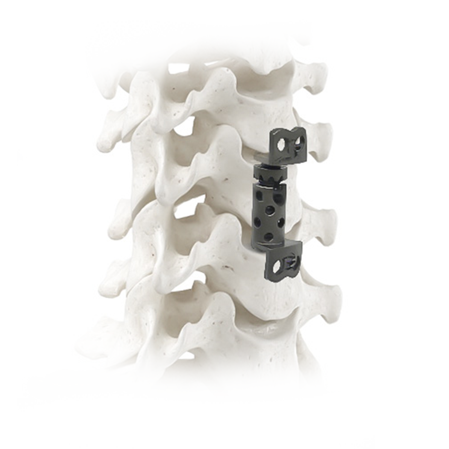 Expandable Titanium Cage II cervical reconstruction