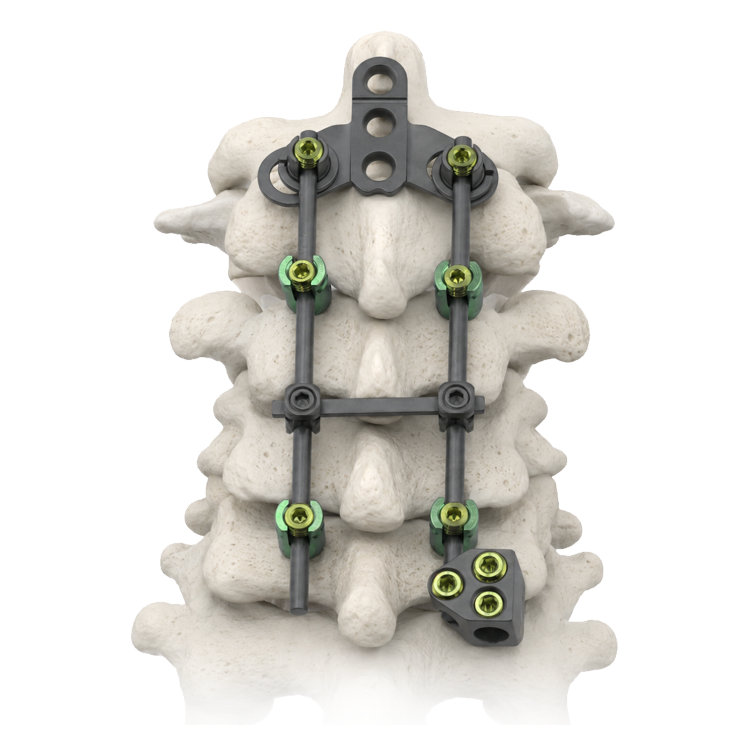 Posterior cervical screw rod fixation system