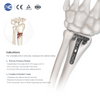 Distal Radius Volar Multi-axial Locking Plate | Titanium Orthopedic Implants & Fracture Fixation