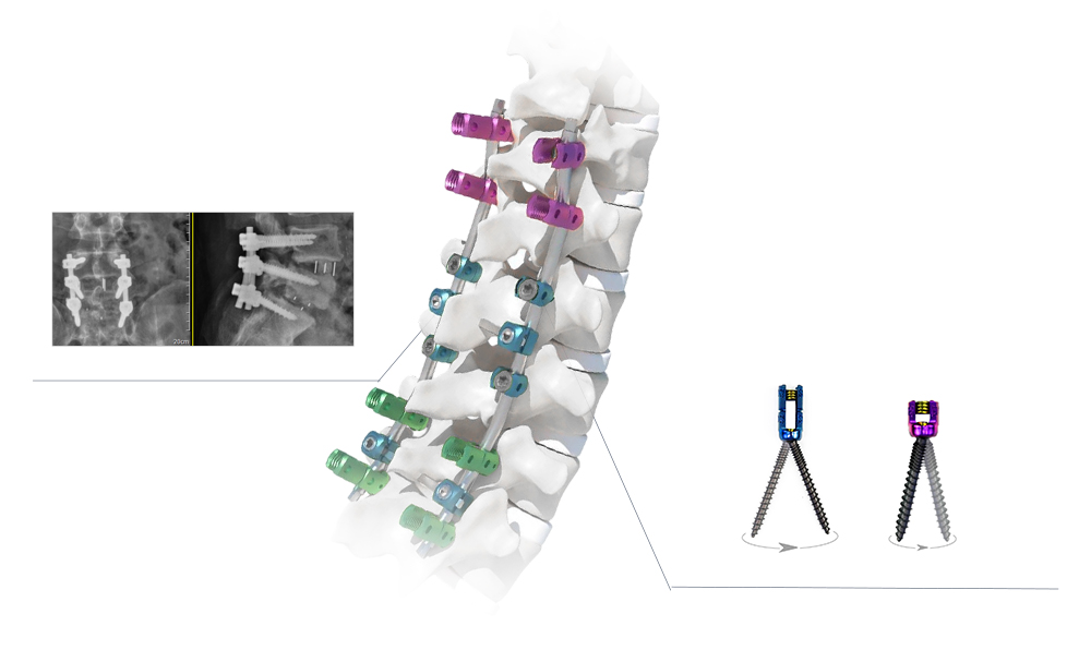 Spinal Pedicle Screw System Product Details and Spinal Alignment Restoration