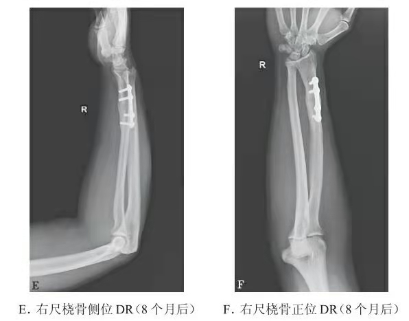 Representative follow-up X-ray showing distal radius union progression