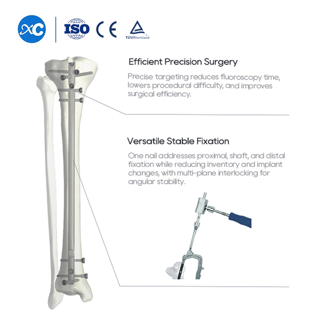Novum Tibia Intramedullary Nail | Orthopaedic Fixation | XC Medico