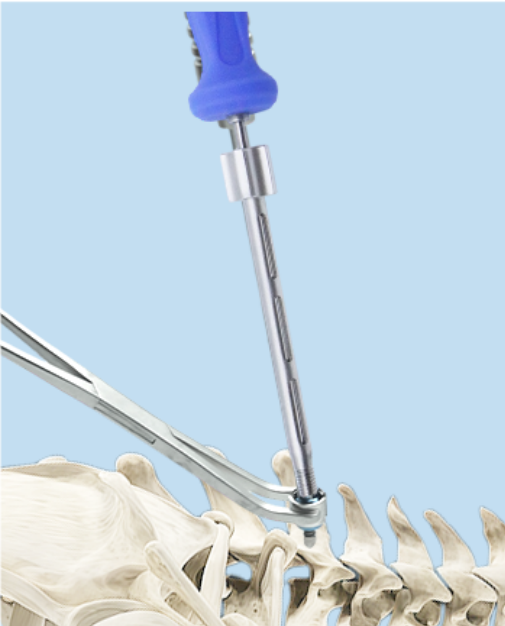 Cervical screw implanting illustration
