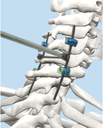 Transverse connector implantation illustration