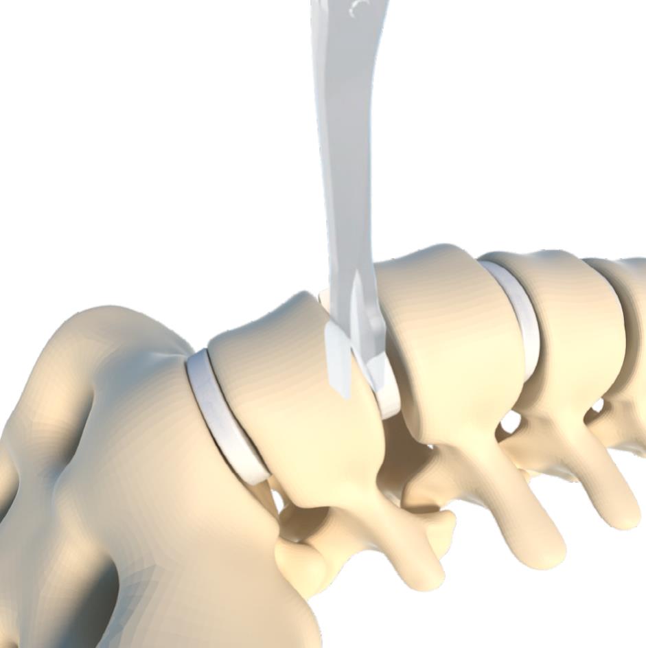 Lumbar segment distraction