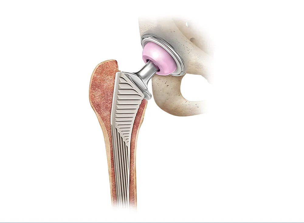 Total hip replacement prosthesis with femoral stem, femoral head, liner and acetabular cup in hip joint