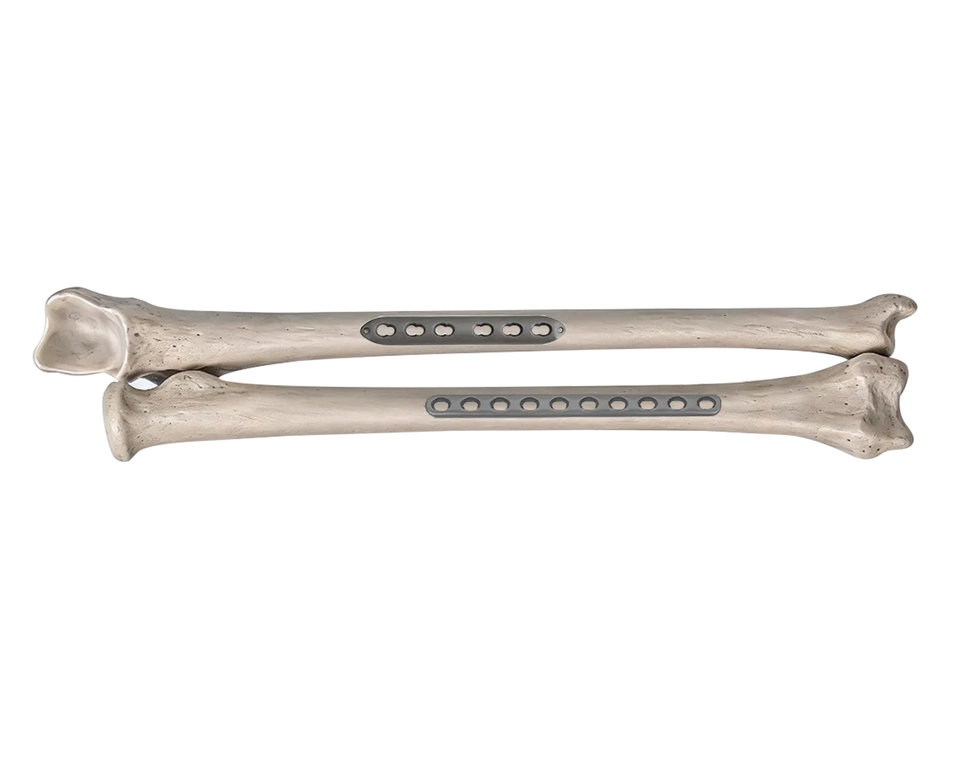 Radius and ulna anatomical model with locking and non-locking plate positions