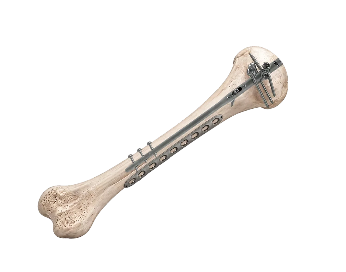 Humeral shaft fracture fixation systems across the upper arm