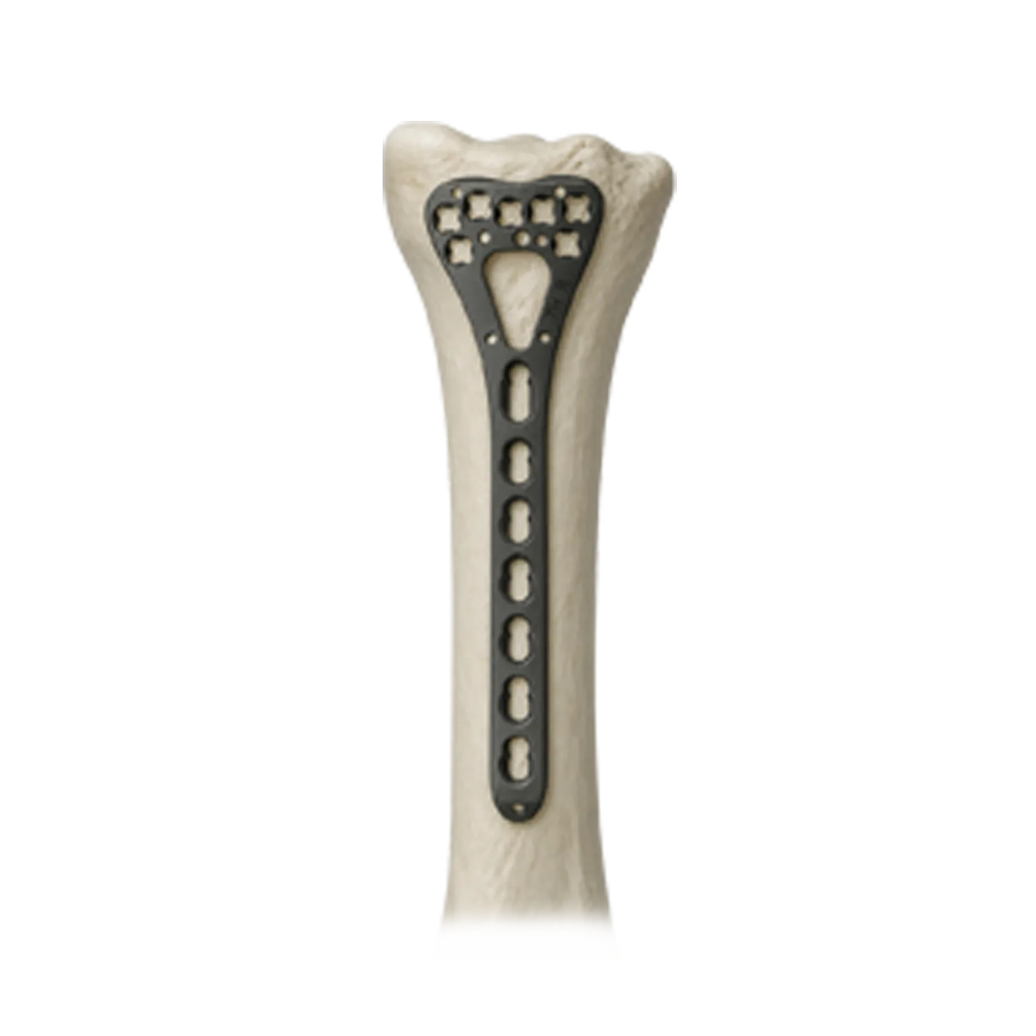 Distal radius locking plate fixed on radius bone model