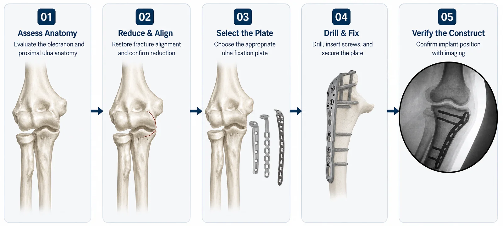 Olecranon avo lenta sy ny fizotry ny fametahana ulna proximal