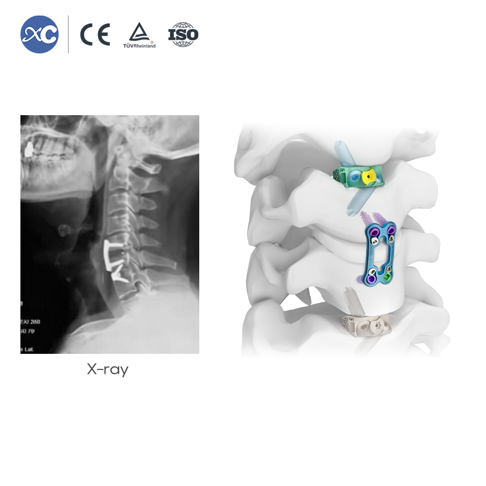 Ensemble ya ba instruments ya Retracteur ya cervix | Lipaso ya ACDF | XC Medico ya monganga