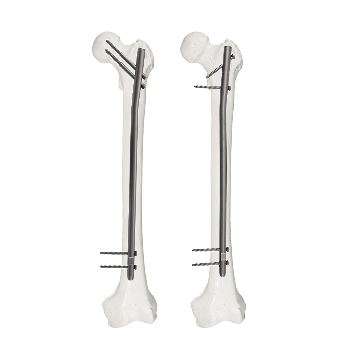 Femoral Reconstruction Intramedullary Nail for Femoral Fracture Fixation | XC Medico