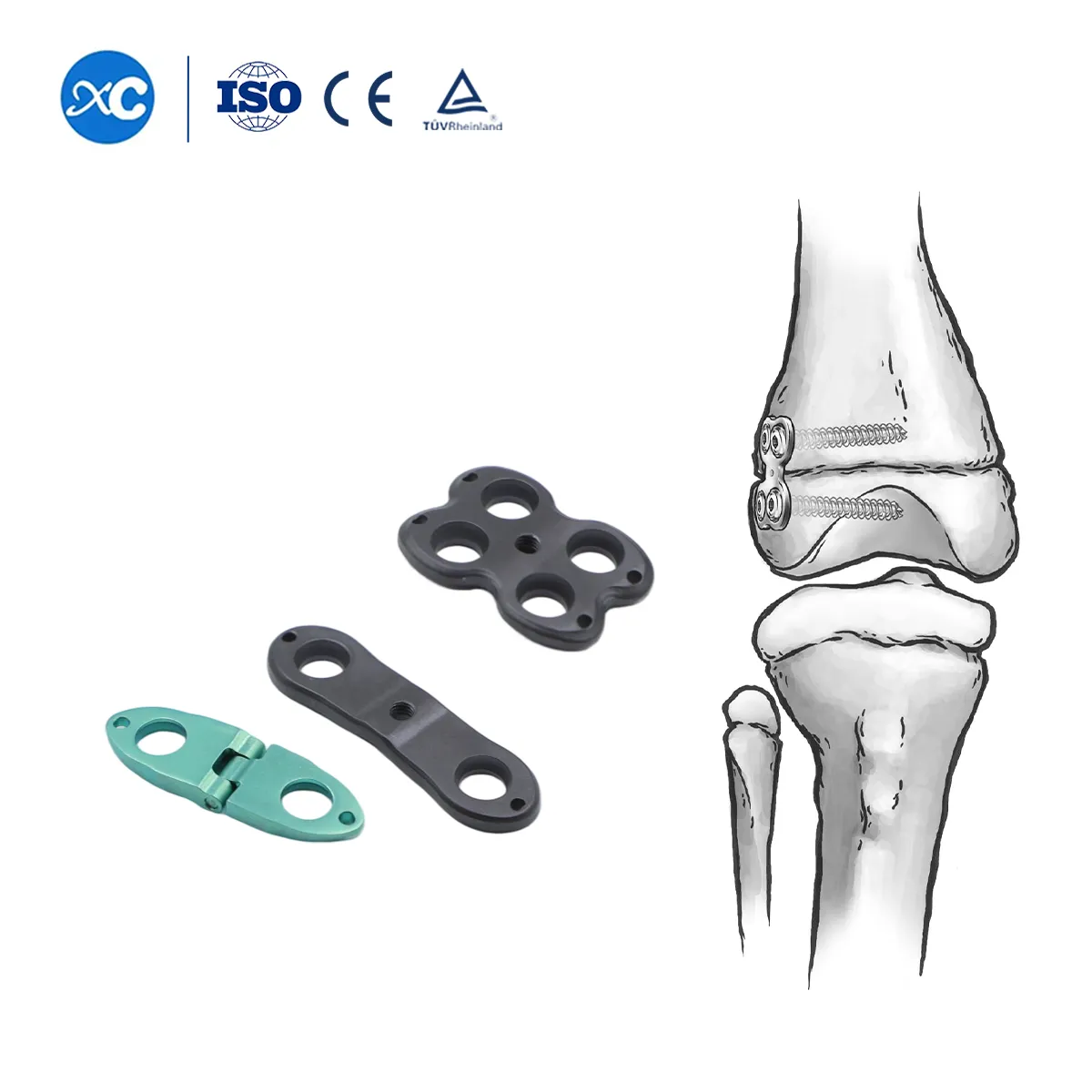 Pediatric Valgus Varus Orthopedic System | Limb Deformity Correction Implant- 6