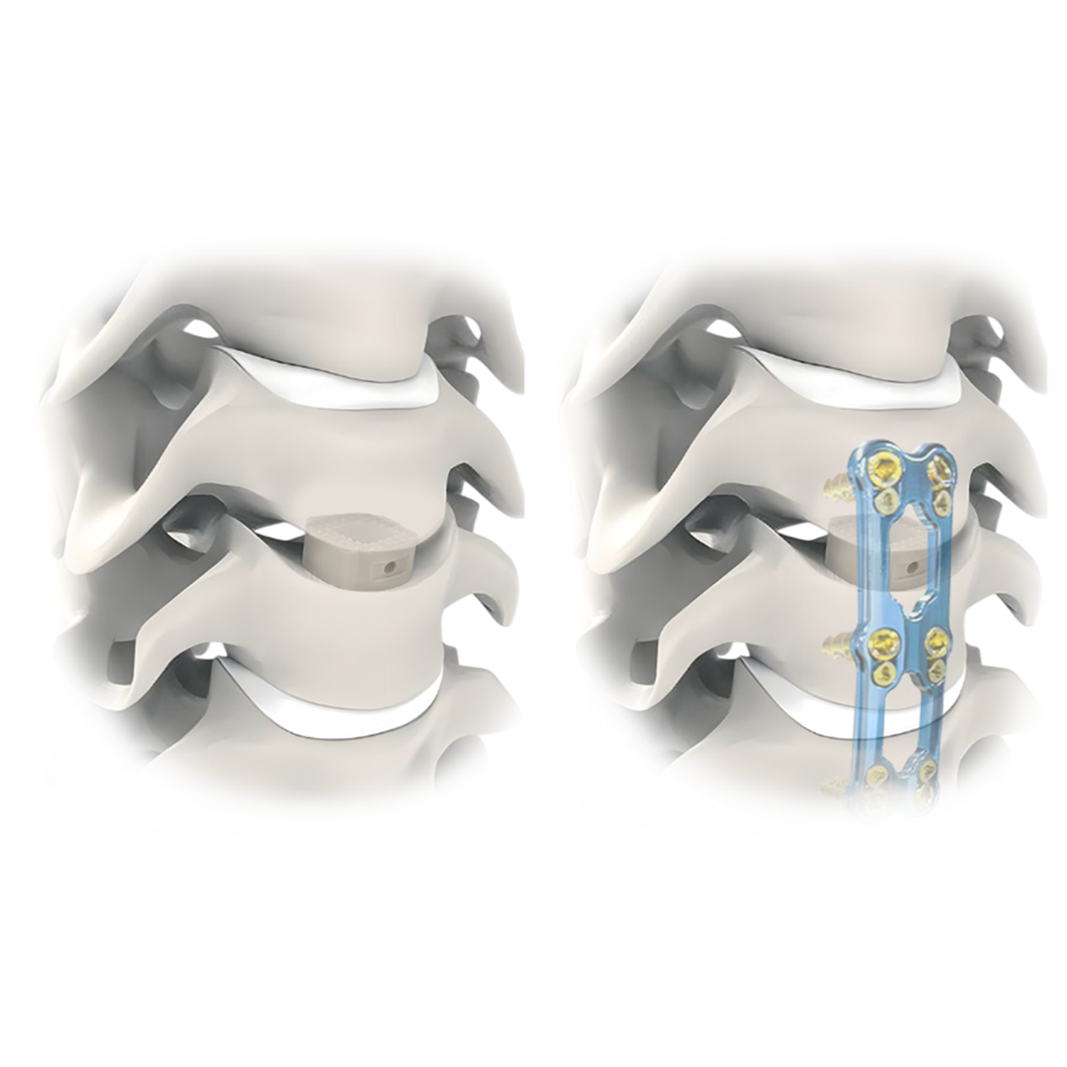 PEEK cervical cage used for anterior cervical interbody fusion