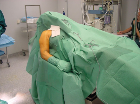 Patient in beach-chair position with left upper extremity supported for proximal humerus fracture surgery