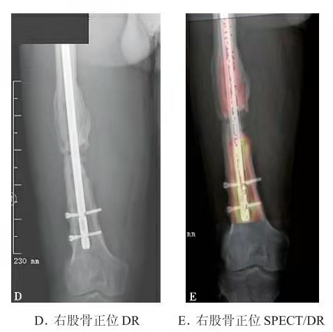 Representative SPECT/CT showing limited tracer activity across femoral fracture line