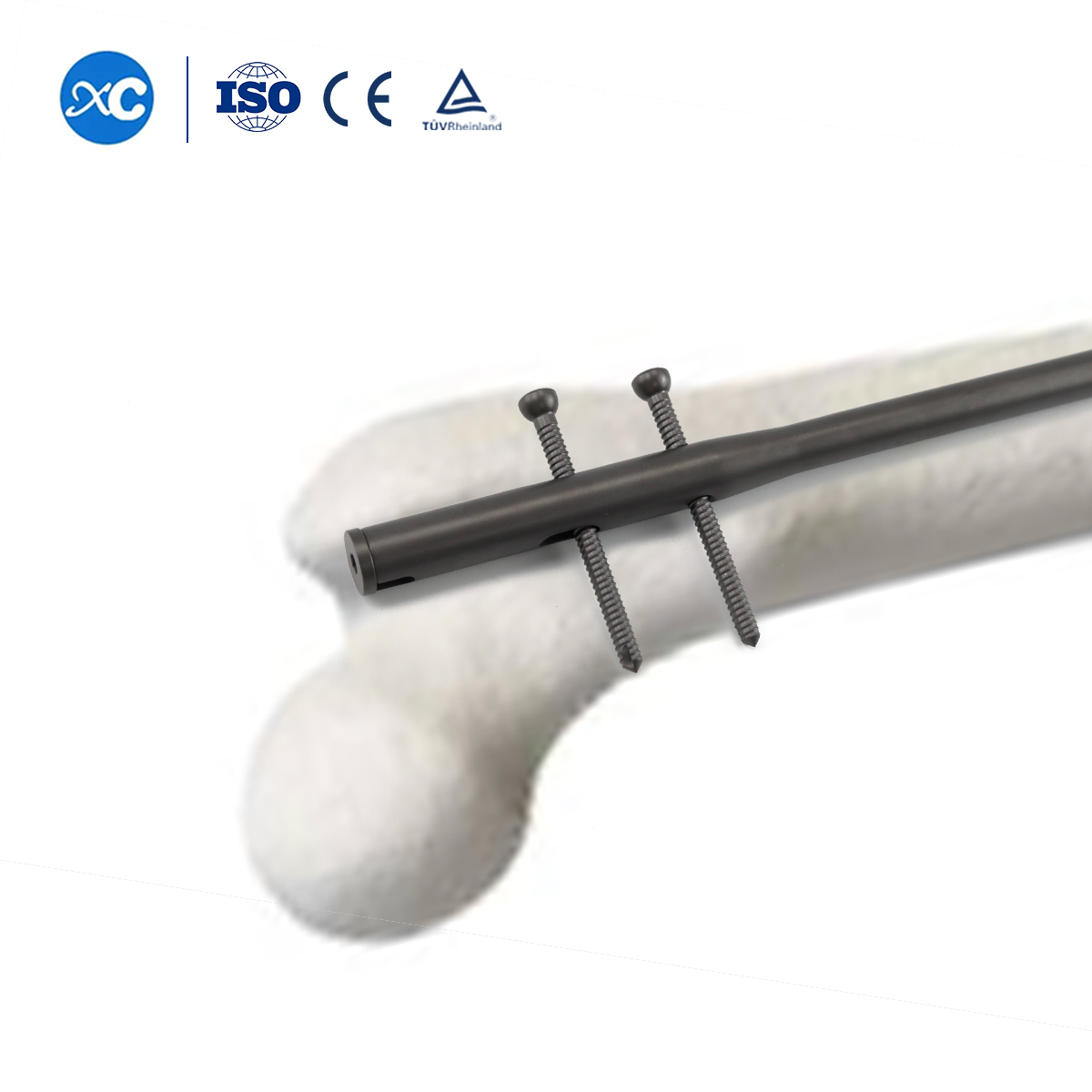 Femoral Intramedullary Nail | Femur Fixation | XC Medico