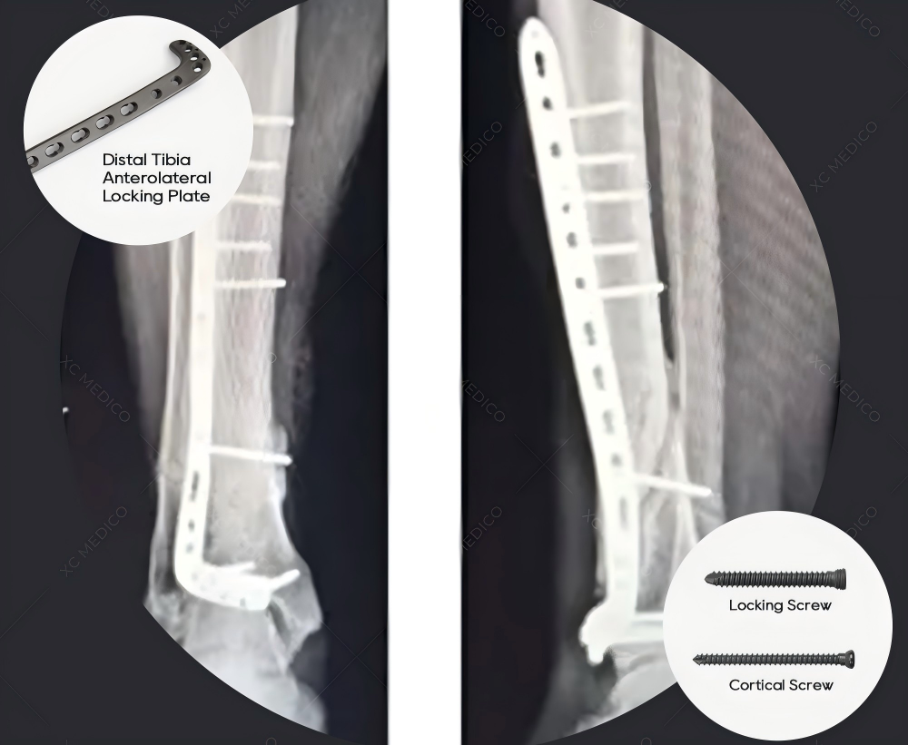 Trauma Implants OEM manufacturing blueprint for a distal tibiofibular locking plate