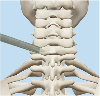 Cortical opening illustration