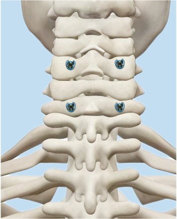 Remaining screw fixation illustration