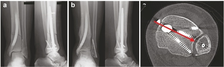 Three-point distal locking configuration showing triangular arrangement of locking screws for metaphyseal stability