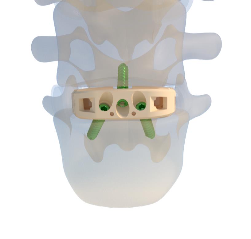 Anterior view of final ALIF cage placement