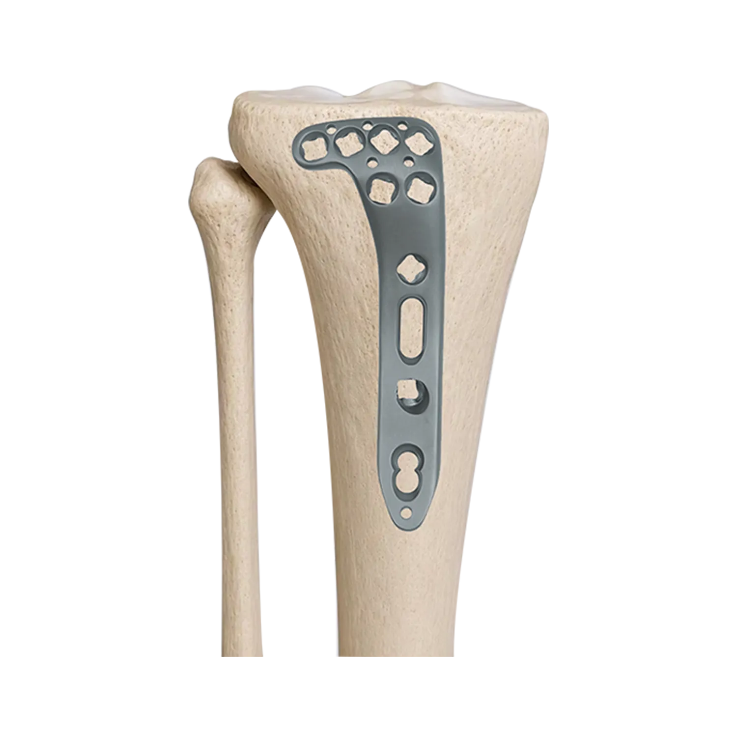 Multi-axial tibial plateau locking plate fixed on lateral proximal tibia bone model
