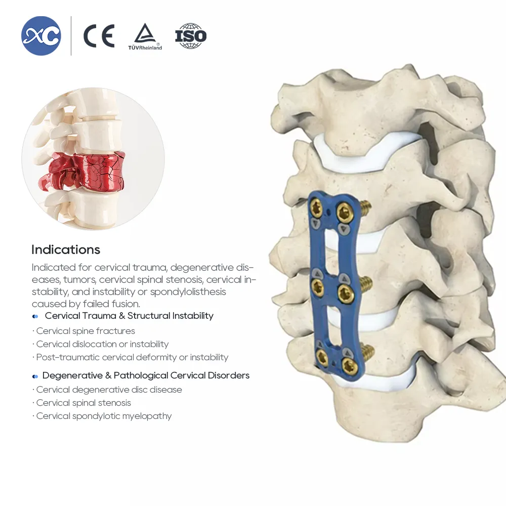 0.8mm Ultra-Thin Anterior Cervical Plate | Cervical Fixation System - 2