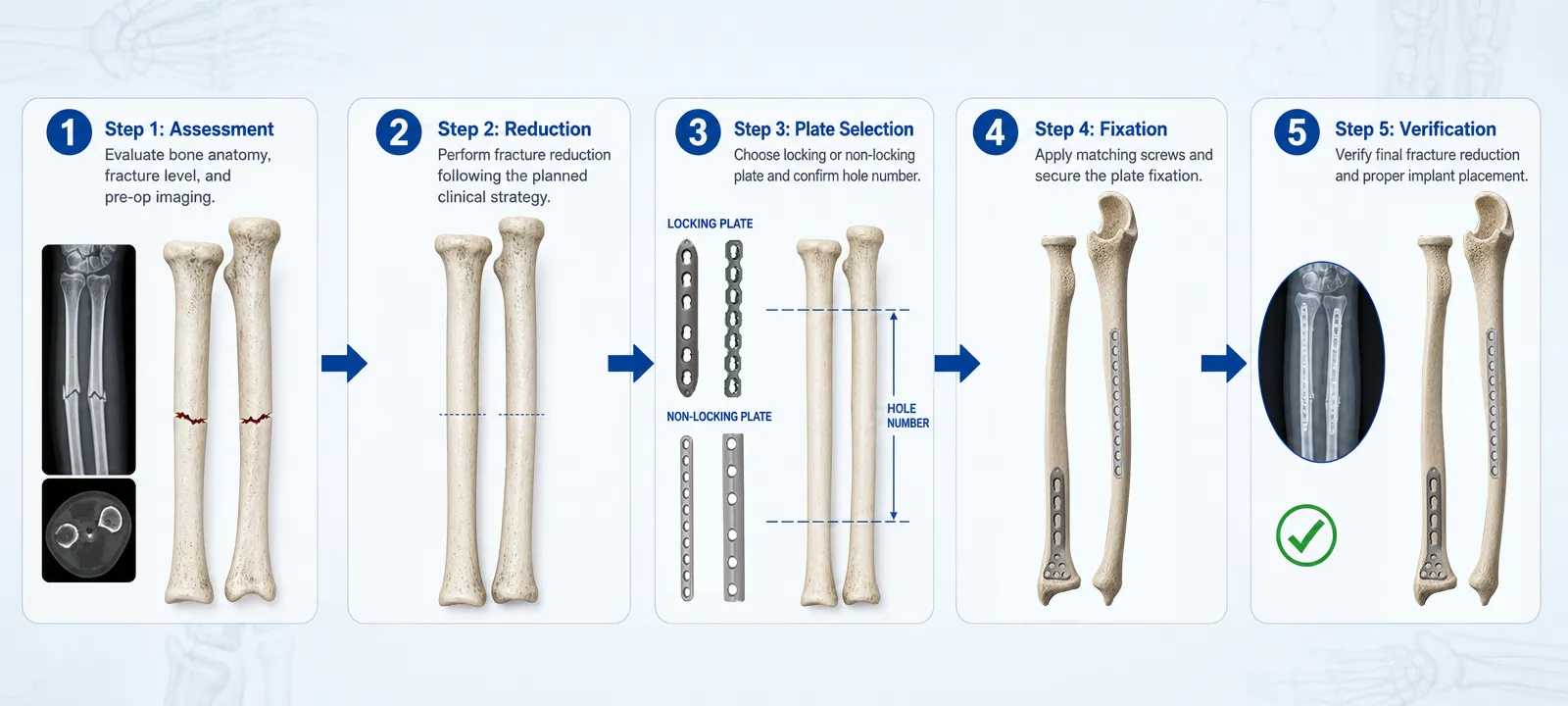 Radius and ulna shaft fixation planning and surgical workflow