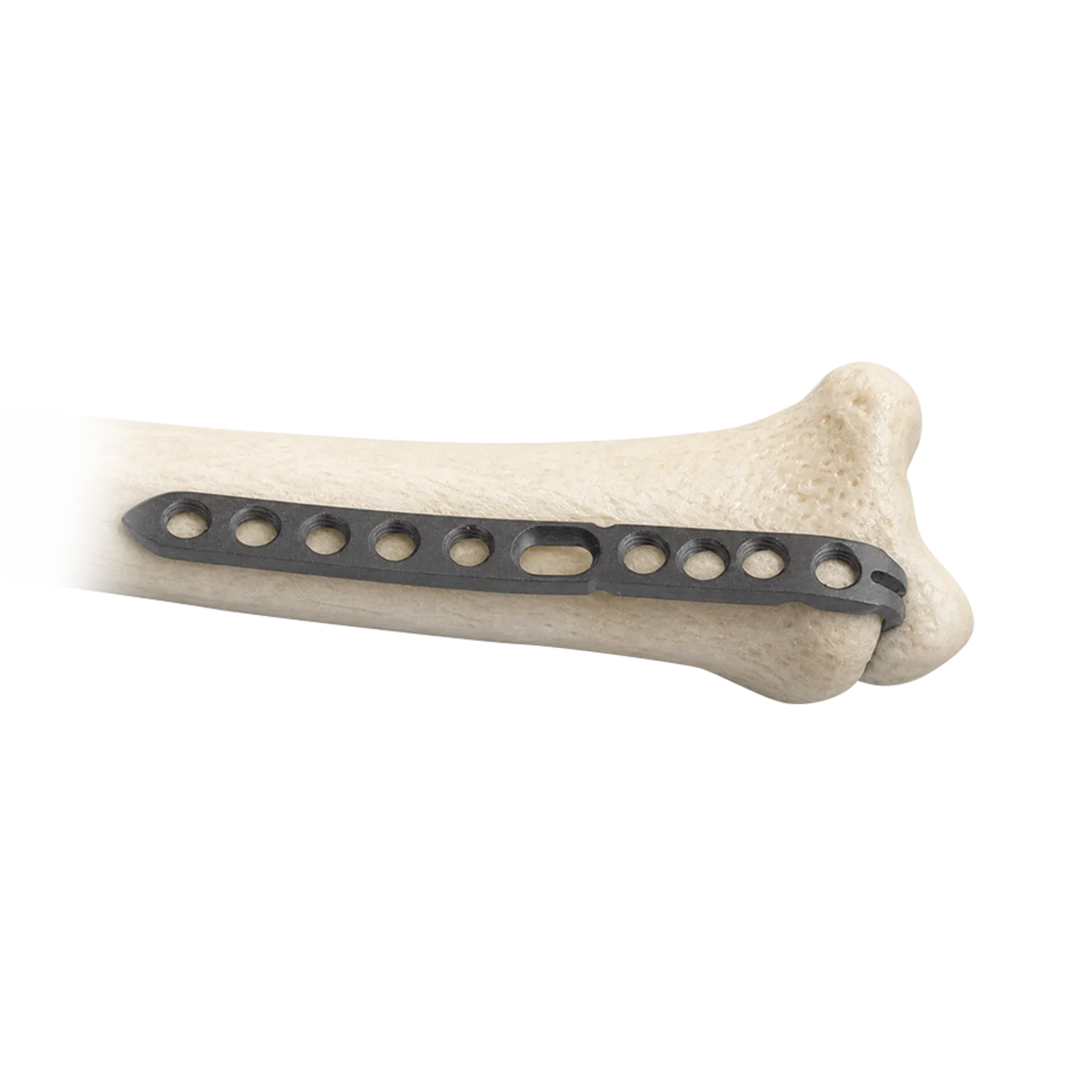 Ulnar styloid locking plate fixed on a distal ulna bone model