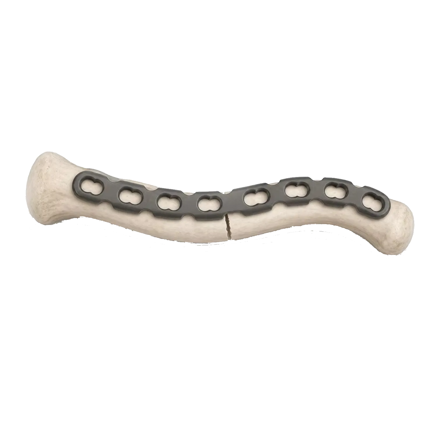 S-clavicle locking plate fixed on a clavicle bone model across a midshaft fracture