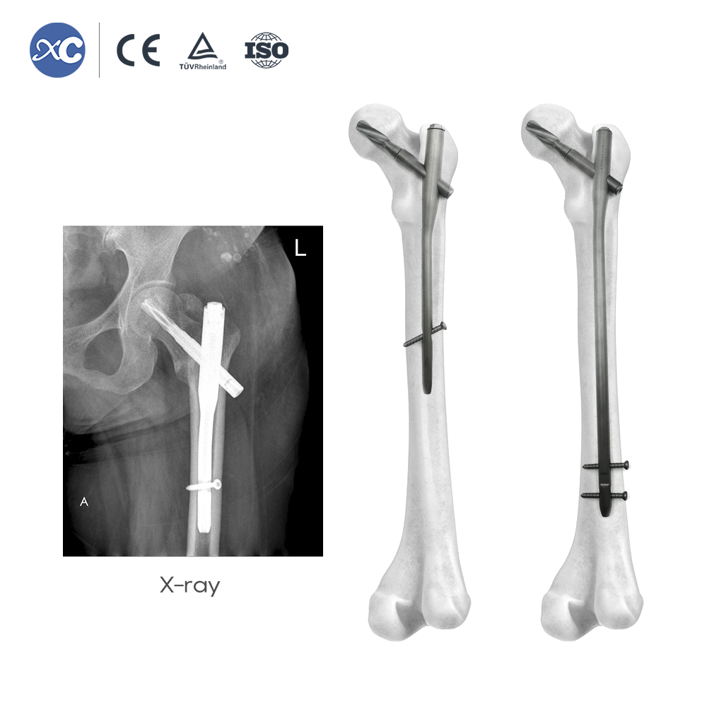 PFNA интрамедуларен пирон | Фиксиране на фрактура на проксимална бедрена кост