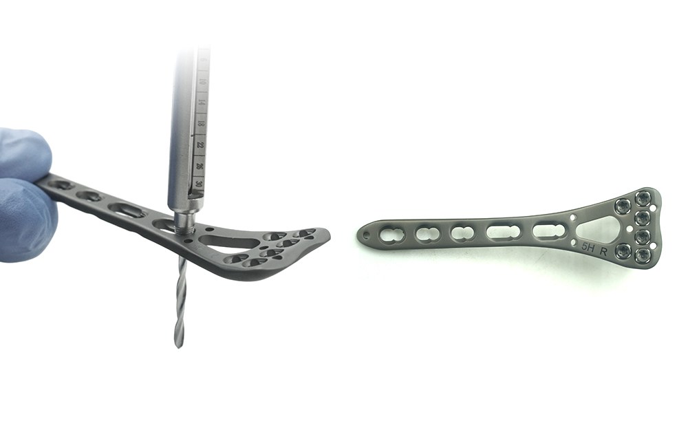 סגסוגת טיטניום פרימיום ועיבוד CNC עבור שתלי רדיוס אורטופדיים