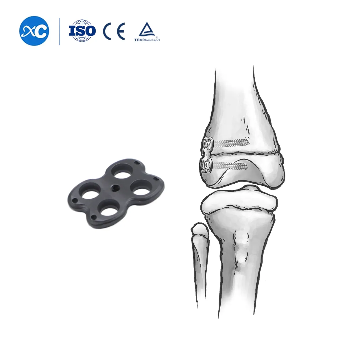 Pediatric Valgus Varus Orthopedic System | Limb Deformity Correction Implant- 3