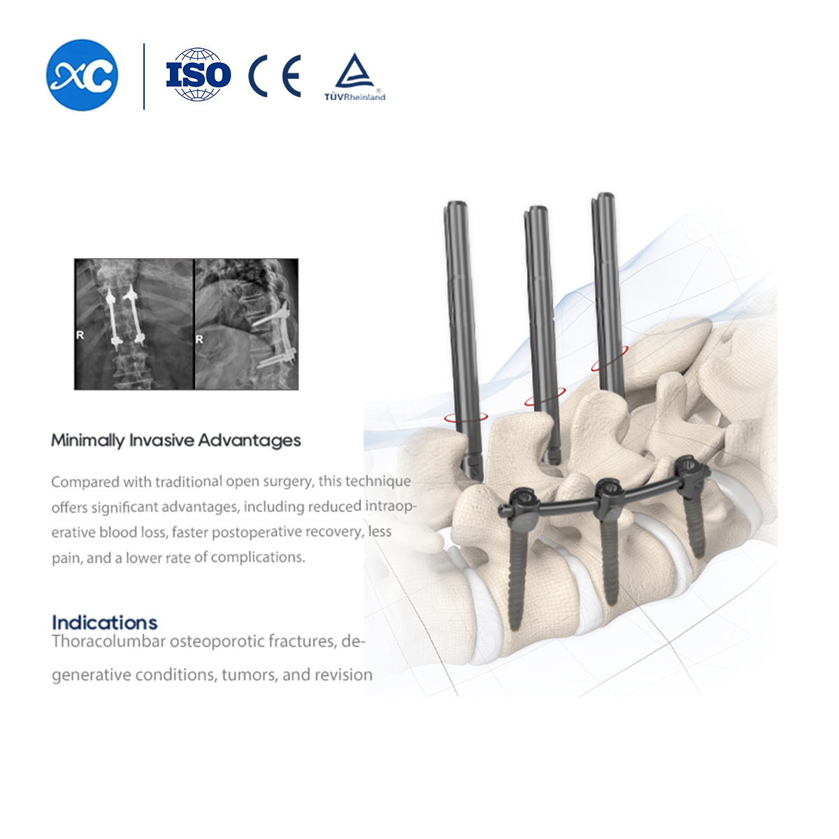 5.5 MIS Spinal System II | Pedicle Screw | XC Medico