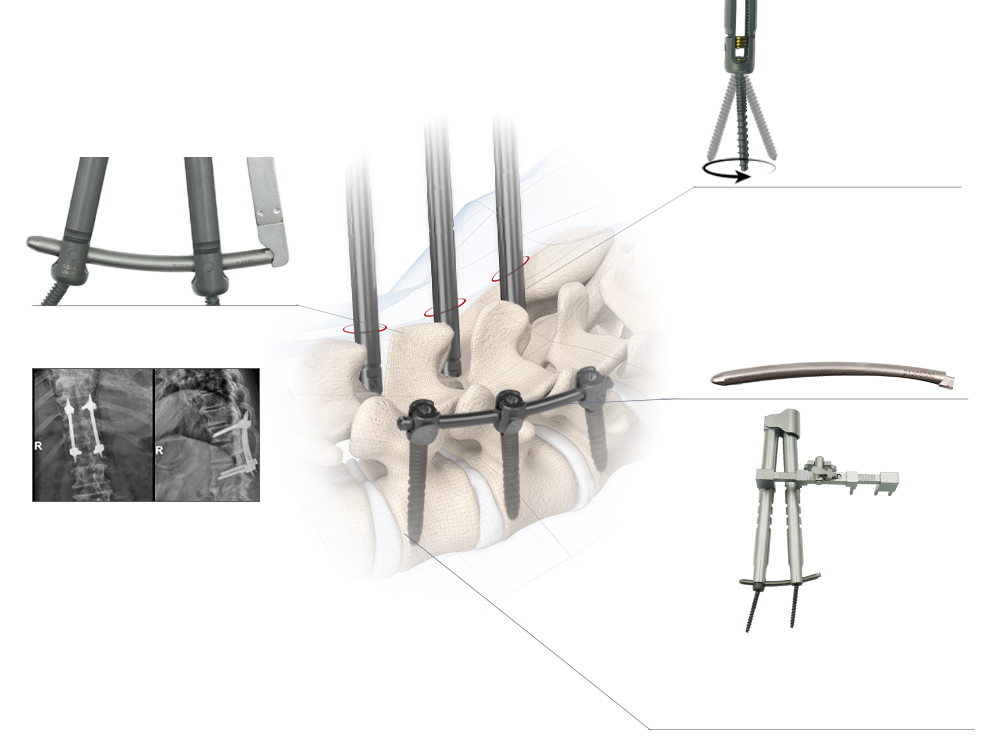 Biomechanics of 5.5 MIS Spinal System: Mechanically Stable, MIS Curved Rod, Compression-Distraction Forceps