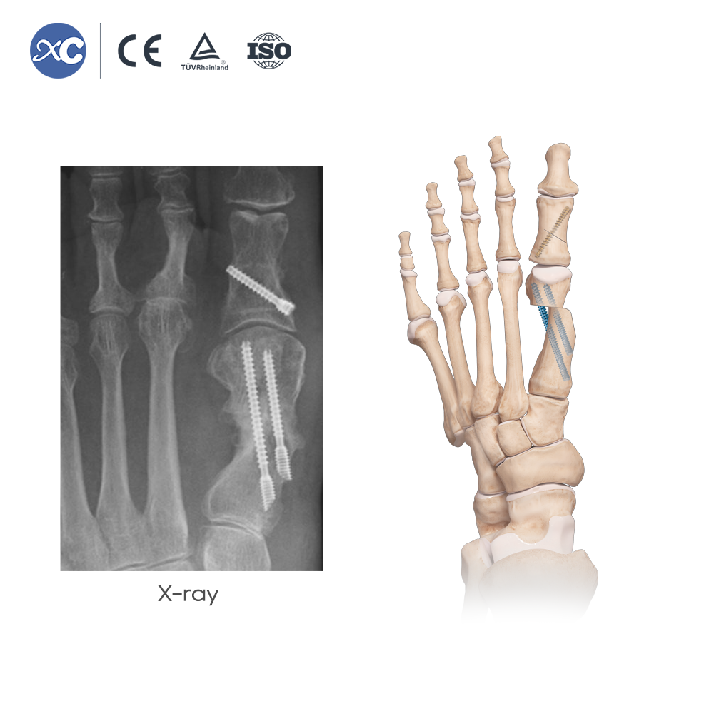 MIS Hallux Valgus Instrument Set | Factory Direct | XC Medico