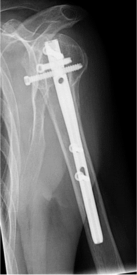 Lateral radiograph at one year confirming anatomic alignment and complete fracture healing