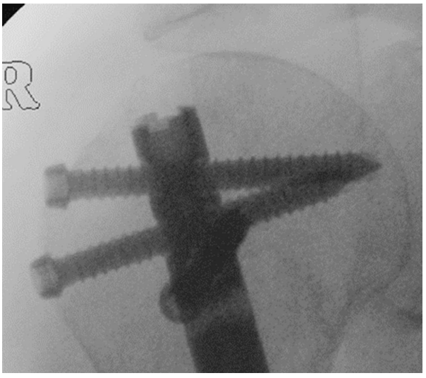 Post-operative radiograph showing perfect intramedullary nail positioning with proximal locking screws seated in subchondral bone