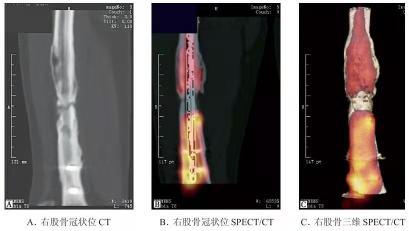Representative X-ray of femoral fracture with intramedullary nail and limited callus