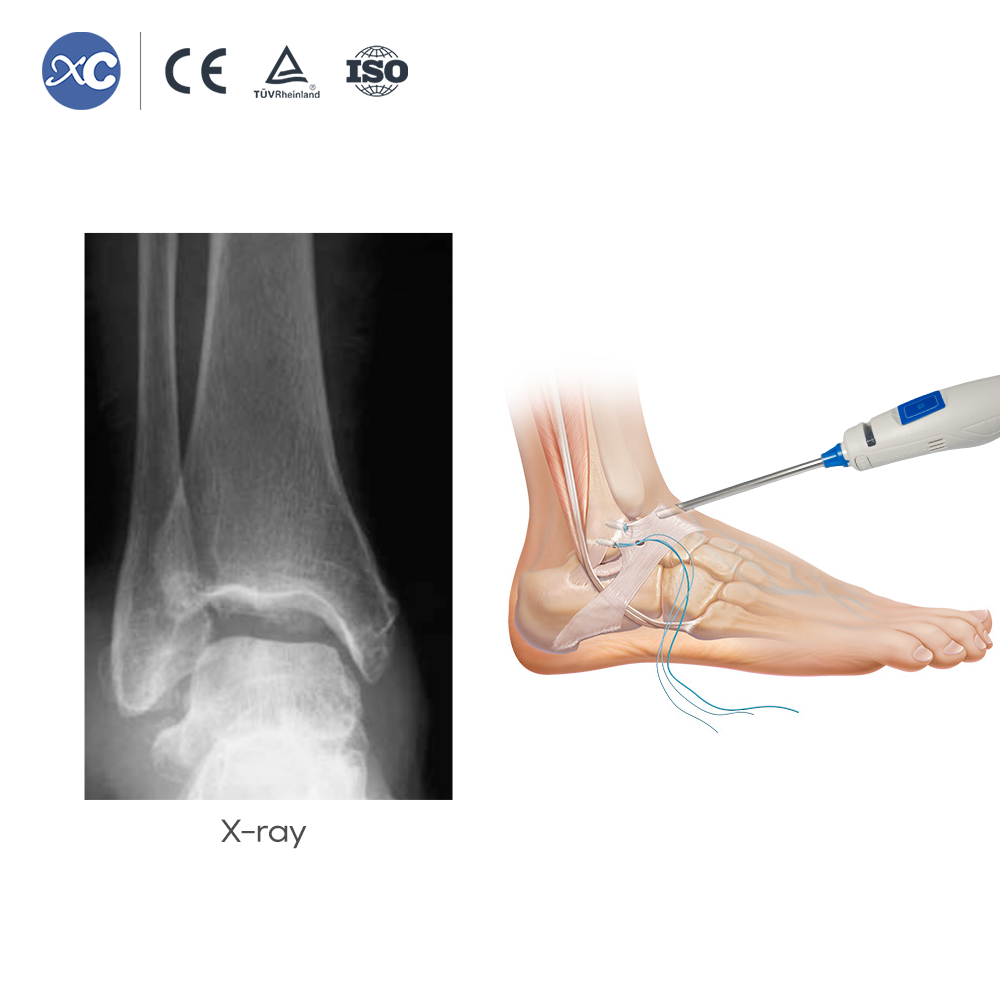 Disposable Arthroscope | Sports Medicine & Spine | XC Medico